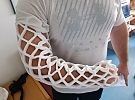 Chrudimská nemocnice nabízí lehkou a voděodolnou fixaci místo klasické sádry